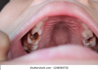 The Boy Had Tooth Decay Because He Did Not Clean His Teeth