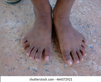 The Boy Have Six Toes  Are Stand Up For Photographers Take Pictures At The Village In The Countryside Of Thailand.Mahasarakham,Thailand,October 2015 