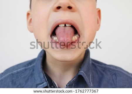 boy, kid performs articulation exercises for mouth, concept of speech disorders, correction, frenum of tongue, methods of correctional developmental exercises
