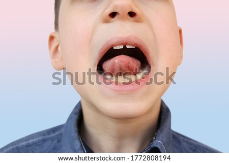 boy, kid performs articulation exercises for mouth, concept of speech disorders, correction, frenum of tongue, methods of correctional developmental exercises