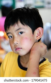Boy and multiple mosquito bites face   arm
