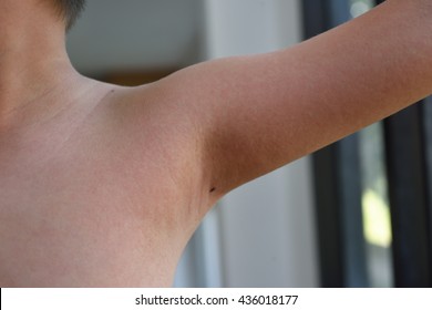 Boy Patient With Rash, Viral Rash, Viral Examthems, Scarlet Fever.