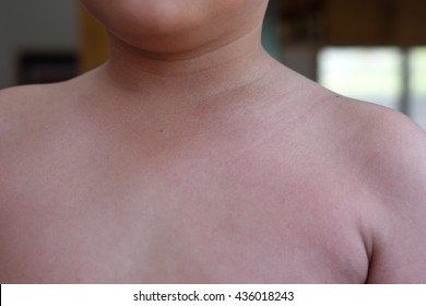 Boy Patient With Rash, Viral Rash, Viral Examthems, Scarlet Fever.