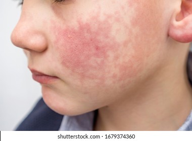 Boy With Red Cheeks- Diathesis Or Allergy Symptoms. Redness And Peeling Of The Skin On The Face. 