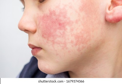 Boy With Red Cheeks- Diathesis Or Allergy Symptoms. Redness And Peeling Of The Skin On The Face. 