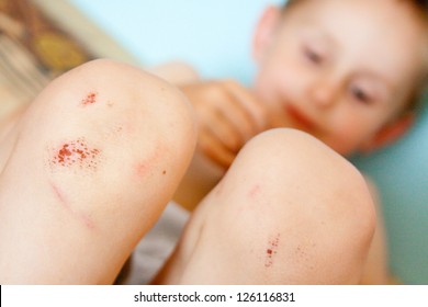 Boy With A Scraped Knee