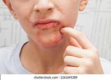 Allergy Mouth High Res Stock Images Shutterstock