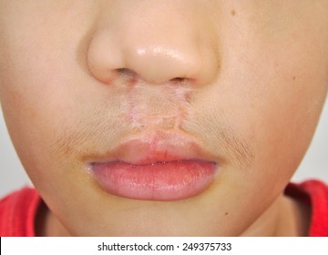 Boy Showing A Bilateral Cleft Lip Repaired