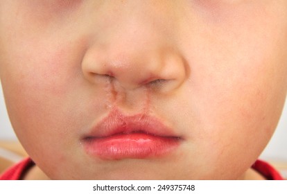 Boy Showing A Bilateral Cleft Lip Repaired