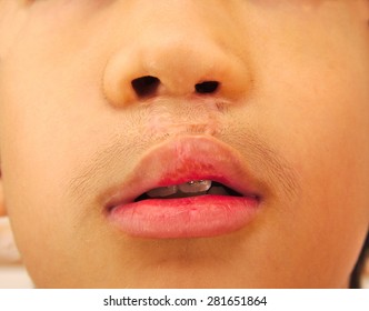 Boy Showing A Bilateral Cleft Lip Repaired