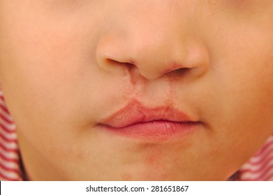 Boy Showing A Bilateral Cleft Lip Repaired