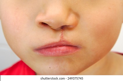 Boy Showing A Unilateral Cleft Lip Repaired