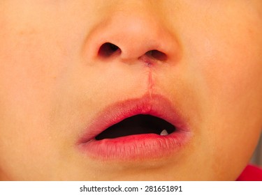 Boy Showing A Unilateral Cleft Lip Repaired