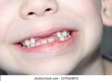 1,973 Teeth falling out Images, Stock Photos & Vectors | Shutterstock
