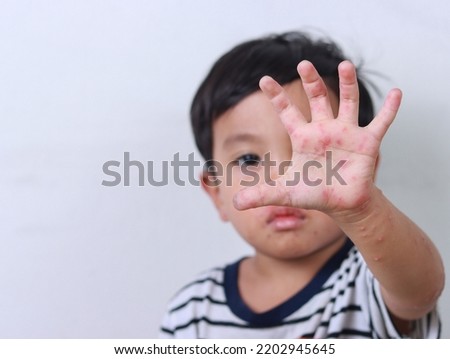 Boy suffering from hand, foot and mouth disease showing hand with rash and painful red blisters on white background