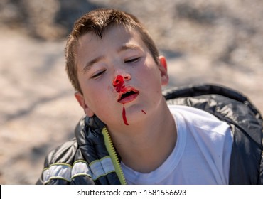 Boy ten years old with his nose bleeding 