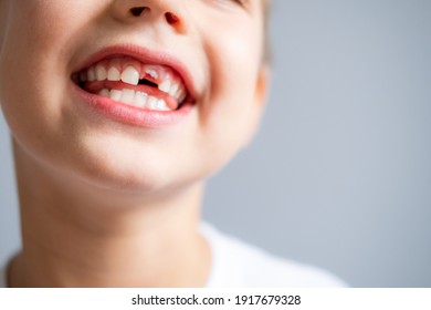 Boy without milk upper tooth in white t-shirt on the gray background. Close up.