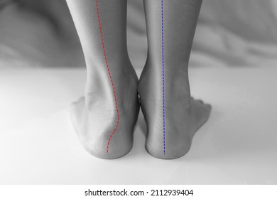 Boy's feet with flat feet or fallen arch, ankle lean inward causing leg length difference. The red line showing abnormal shapes flat foot compare to normal foot. - Shutterstock ID 2112939404