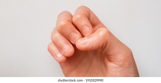 boys hand with chewed fingernails on white background - kids hand with short fingernails