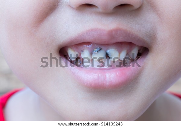 Boys Love Eat Candy Which Causes Stock Photo Edit Now 514135243