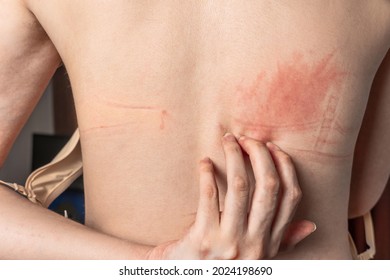 Bra marks on the back. The girl rubbed her back with her underwear. Uncomfortable bra. The wrong size underwear. Traces of clothing on the body. A woman's body. Body positive, self-love, self-care.