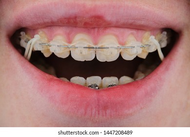 banded braces