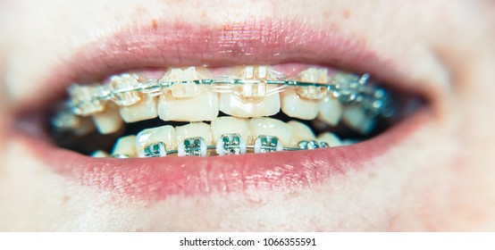 green colored braces