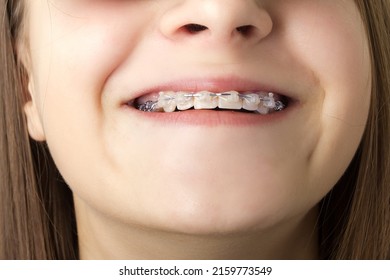 braces on a teen, a teenager's mouth close-up at the orthodontist for dental treatment, bite correction