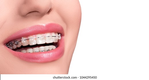 Braces On Teeth. Dental Braces Smile. Orthodontic Treatment. Closeup Smiling Face With Braces. Isolated On White Background.
