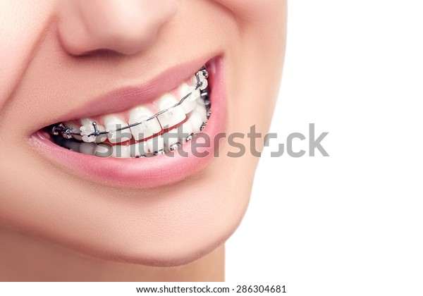 Braces Tratamiento Ortodontico Concepto De Atención Dental Hermosa