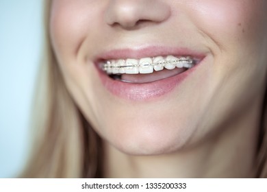 Braces, Treatment For A Crooked Teeth, Closeup Photo Of A Beautiful Smile Of A Young Woman With White Clean Teeth, Aesthetic Dentistry And Dental Care Concept