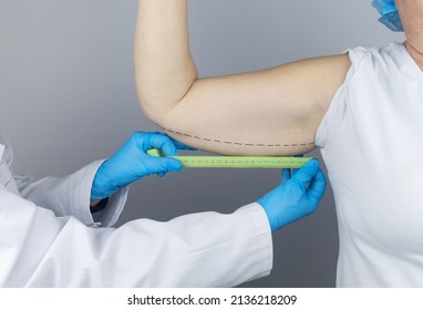 Brachioplasty. Plastic Arms, Dangling Skin At The Elbow. An Older Woman Shows The Surgeon Problem Areas Of The Forearm. Examination Before Cosmetic Surgery