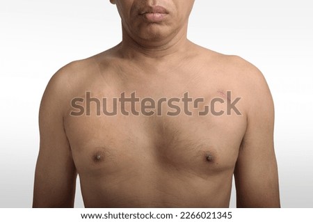 Bradycardia patient having pacemaker implanted. Undressed patient 3 months after having a defibrillator