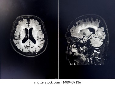 817 Brain Atrophy Images, Stock Photos & Vectors | Shutterstock