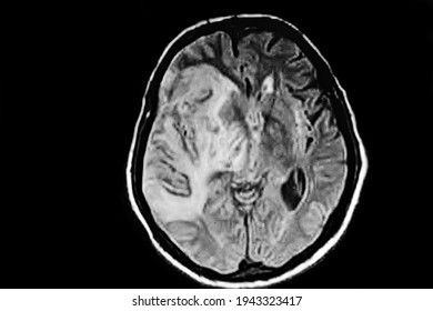 Brain CAT SCAN. Middle Cerebral Artery ​​extensive Right Ischemia Of The Brain