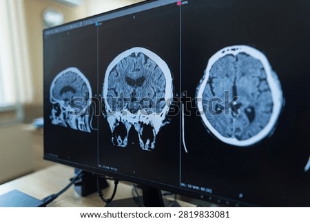 A brain CT or MRI scan displayed on a professional computer monitor screen in a clinic, showing axial, sagittal, and coronal views for medical diagnosis of a head injury or stroke.
