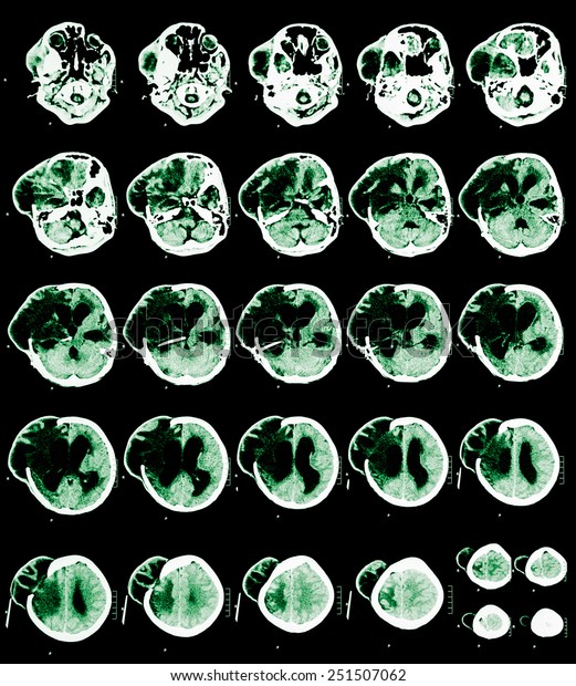 Brain CT Scan green image is\
divided into different levels. To detect abnormalities of the\
brain. Due to formation of oedemas area right side of ventricles\
brain.