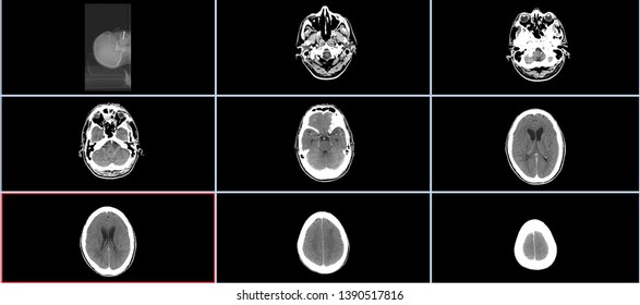 Brain Ct Scan Head Computed Tomography Stock Photo (Edit Now ...