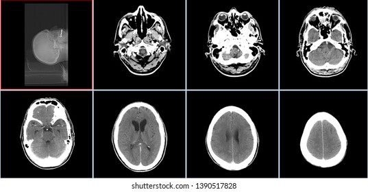 Brain CT Scan (Head Computed Tomography) High Resolution