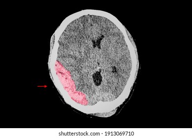 A Brain CT Scan Of A Patient With Traumatic Injury Showing Large Lens Shaped Epidural Hemorrhage (EDH). 