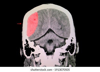 A Brain CT Scan Of A Patient With Traumatic Injury Showing Large Lens Shaped Epidural Hemorrhage (EDH).