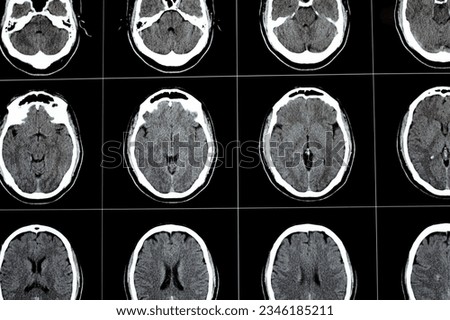 Brain CT scan showing brainstem cavernoma, right centrum semiovale developmental venous anomaly, intra cerebral haematoma, faint hypodense lesion in medulla oblongata and pontomedullary junction
