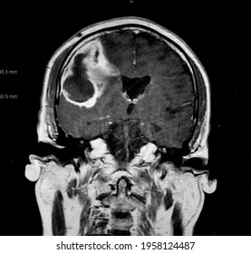 Brain CT Showing E. Coli Brain Abscess