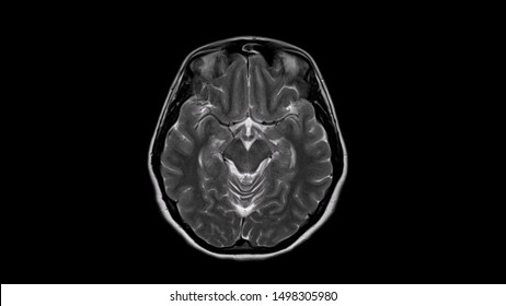 Brain MRI Scan Of Healthy Male  (Axial View Magnetic Resonance Imaging) High Resolution 