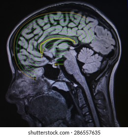 Brain Mri Seizures Stock Photo 286557635 | Shutterstock