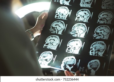 Brain Scan For Dementia 