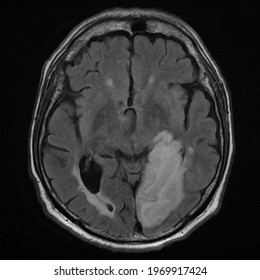 Brain Stroke, Head MRI Flair