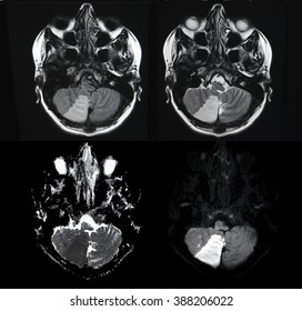 Brain Stroke, MRI