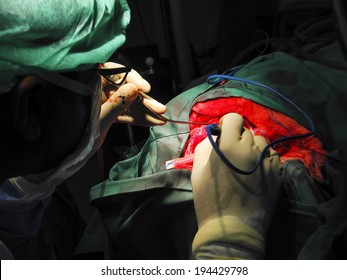 Brain Surgeon In Operating Theater