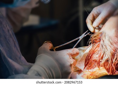 Brain Surgery, Suturing Of The Skin With A Surgical Needle In The Forehead.